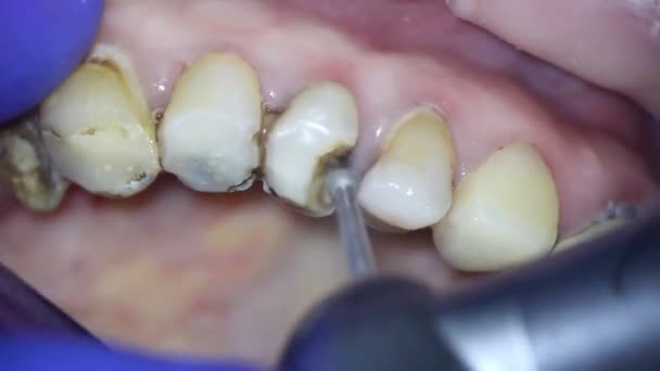 Stomatologii Strzelanie Mikroskopem Nekrektomia Dentysta Usuwa Stare Wypełnienie Specjalnymi Narzędziami — Wideo stockowe