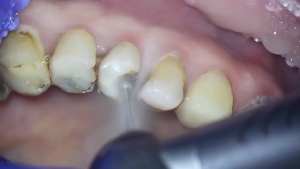 Stomatologii Strzelanie Mikroskopem Nekrektomia Dentysta Usuwa Stare Wypełnienie Specjalnymi Narzędziami — Wideo stockowe