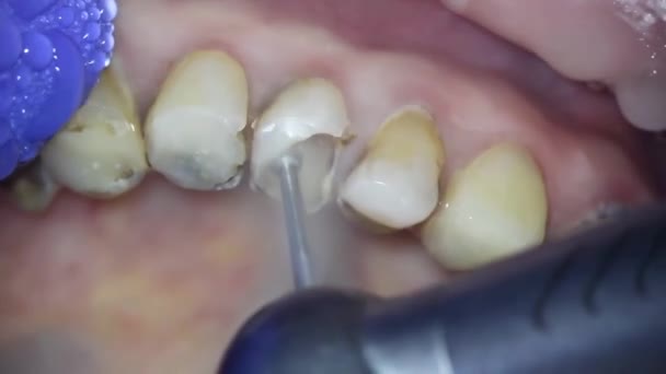 歯医者さん 顕微鏡で撮影しました ネクタイよ 歯医者は特別なツールで古い充填を削除し それらを削除することで損傷した歯の組織を処理します — ストック動画