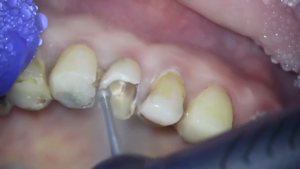 Odontología Disparando Con Microscopio Necrectomía Dentista Elimina Relleno Antiguo Con — Vídeo de stock