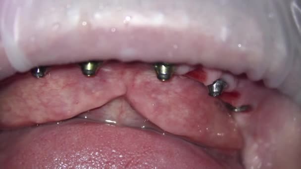 Zubní Lékařství Mikroskopická Fotografie Vyšetření Dutiny Ústní Implantáty Horní Čelisti — Stock video