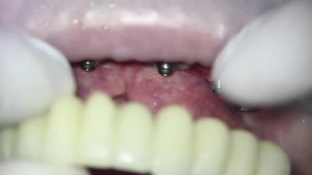 Odontología Disparando Con Microscopio Instalación Dientes Metal Plástico Para Paciente — Vídeo de stock