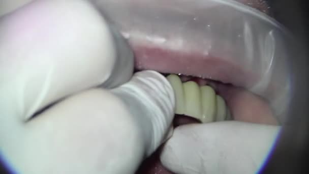 Zubařství Mikroskopem Montáž Kovových Plastových Zubů Pro Pacienta Klinice Horní — Stock video