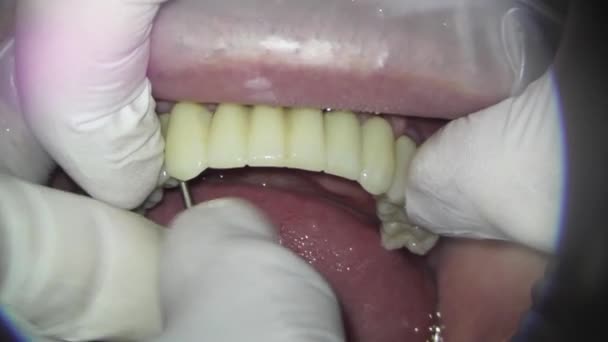 Tandvård Fotografering Med Mikroskop Installation Metall Plast Tänder För Patient — Stockvideo