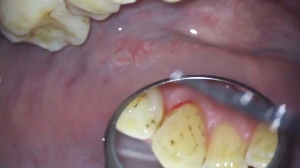 Tandvård. fotografering med mikroskop. tandvård. undersökning av tändernas inre yta med en spegel — Stockvideo