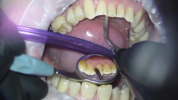 Tandvård. fotografering med mikroskop. tandvård. borsta tänderna med en läskstråle med en dammsugare — Stockvideo