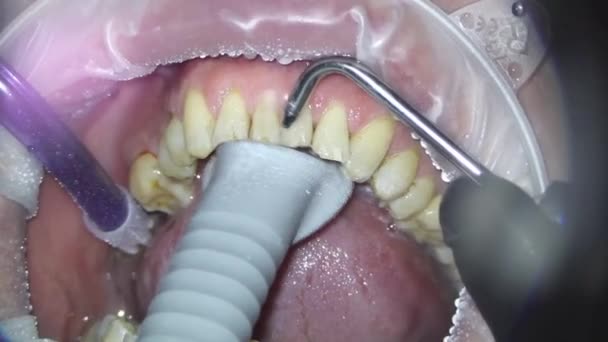 Odontología. disparando con un microscopio. tratamiento dental. cepillarse los dientes con un chorro de soda con una aspiradora — Vídeos de Stock