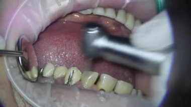 Dişçilik. Mikroskop ile ateş etmek. Eski dolguların çıkarılması ve hasarlı diş dokularının tedavisi