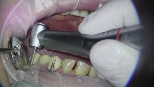 牙科学。用显微镜拍摄。清除旧填充物及处理受损的牙齿组织 — 图库视频影像