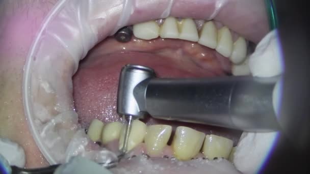 치과의 사요. 현미경으로 촬영. 오래 된 충전재를 제거하고 손상된 치아 조직의 치료 — 비디오