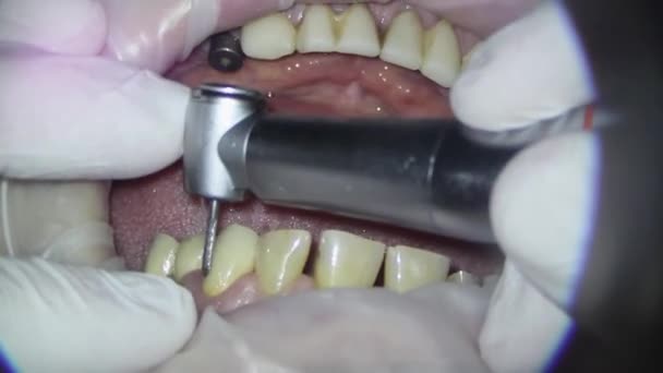 Dentistry. shooting with a microscope. removal of old fillings and treatment of damaged tooth tissues — Stock Video