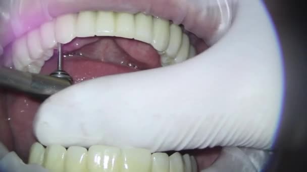 Fixierung einer Zahnbrücke mit einem Drehmomentschlüssel — Stockvideo