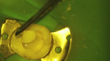 Dişçilik. Mikroskop fotoğrafçılığı. Diş tedavisi. Diş boşluğunda tirbuşonla doldurulmuş bir fotopolimer yerleştirilmiş.