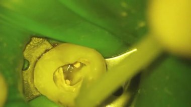 Dişçilik. Mikroskop fotoğrafçılığı. Diş tedavisi. Fotopolymer 'i diş çukurunda tirbuşonla doldurmak.