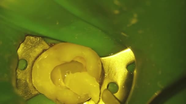 Odontología. fotografía del microscopio. tratamiento dental. embestir un relleno de fotopolímero con un sacacorchos en el hueco de un diente — Vídeo de stock