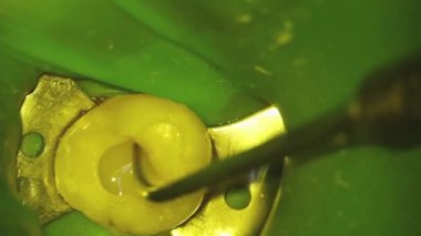 Dişçilik. Mikroskobik fotoğrafçılık. Diş tedavisi. Diş boşluğunda tirbuşonla doldurulmuş bir fotopolimer yerleştirilmiş. Yüksek kalite FullHD video