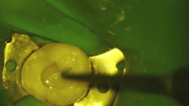 Dişçilik. Mikroskobik fotoğrafçılık. Diş tedavisi. Diş boşluğunda tirbuşonla doldurulmuş bir fotopolimer yerleştirilmiş. Yüksek kalite FullHD video