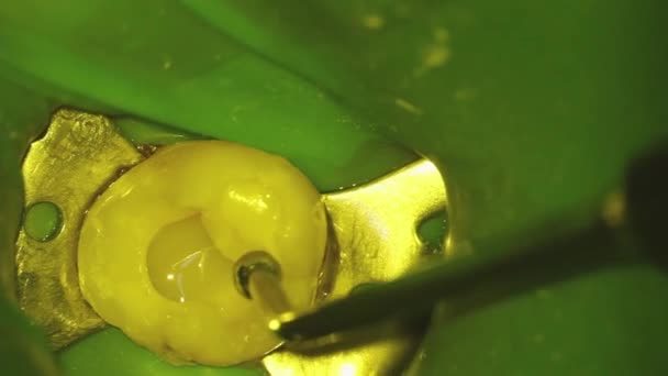 Odontología Disparando Con Microscopio Tratamiento Dental Alineación Con Gancho Dental — Vídeo de stock