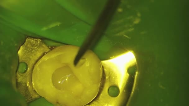 Zahnmedizin. Mikroskopische Fotografie. Zahnbehandlung. Installation einer Photopolymerfüllung mit einer Kelle mit einem Korkenzieher in der Zahnhöhle. Hochwertiges FullHD-Video