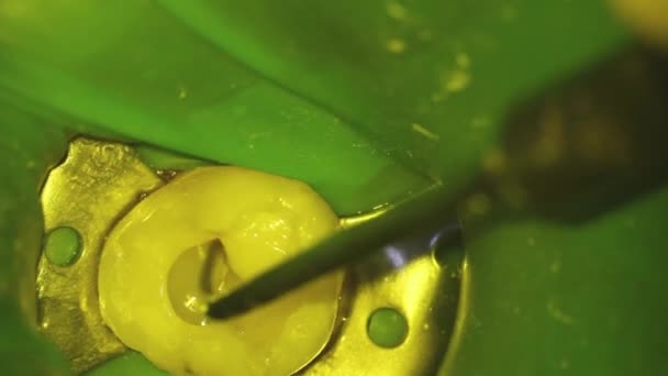 Οδοντιατρική Μικροσκοπική Φωτογραφία Οδοντιατρική Περίθαλψη Εγκατάσταση Φωτοπολυμερούς Πλήρωσης Μυστρί Τιρμπουσόν — Αρχείο Βίντεο