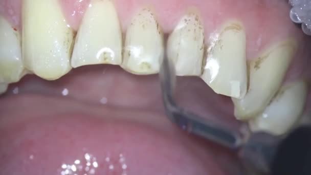 Odontología Fotografía Del Microscopio Eliminación Placa Dental Con Chorro Soda — Vídeo de stock