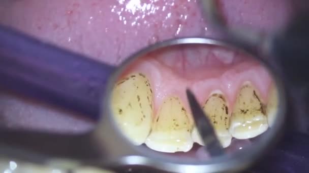 Odontología Fotografía Del Microscopio Eliminación Placa Dental Con Chorro Soda — Vídeos de Stock