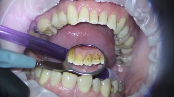 Tandvård Mikroskopfotografering Eliminering Tandplack Med Jetstråle Läsk Salivejektor Fungerar — Stockvideo