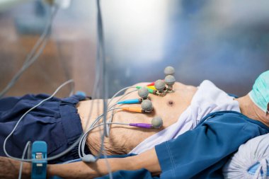 Elektrokardiyogram için elektrodları olan bir hastanın EKG 'si ya da EKG' si hastanede yatıyor..