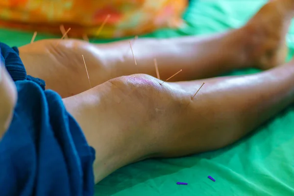 Nahaufnahme Von Khee Und Bein Mit Stahlnadel Während Der Akupunkturtherapie — Stockfoto