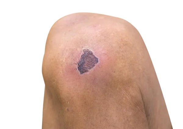 Torkade sår på knäet — Stockfoto