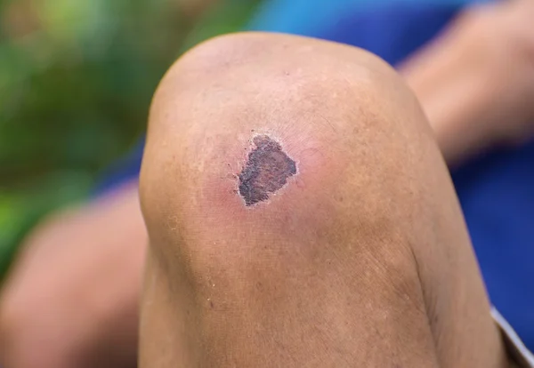 Getrocknete Wunde am Knie — Stockfoto