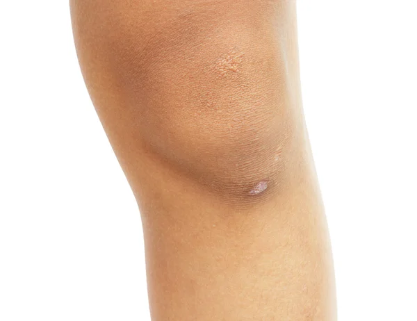 Cicatriz no joelho do menino, menino 11 anos de idade isolar no branco backg — Fotografia de Stock