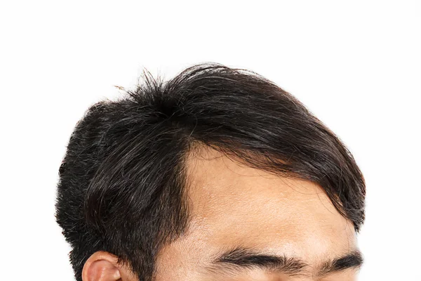 Cabeza masculina con síntomas de pérdida de cabello en la parte frontal —  Fotos de Stock