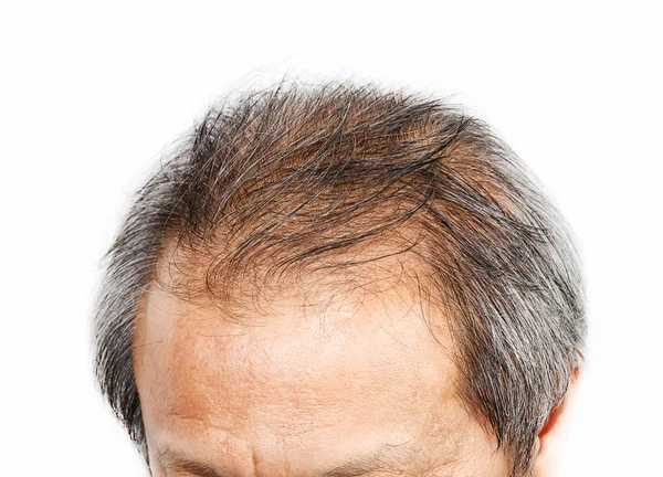 Cabeza masculina con síntomas de pérdida de cabello en la parte frontal . —  Fotos de Stock