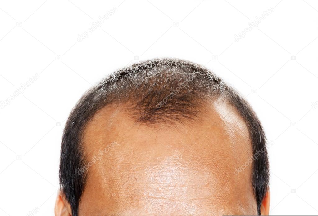Male head with hair loss symptoms front side.
