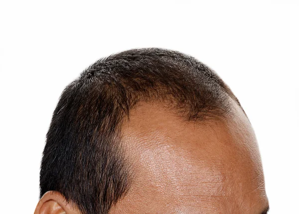 Hair loss , Male head with hair loss symptoms front side. — Stock Photo, Image