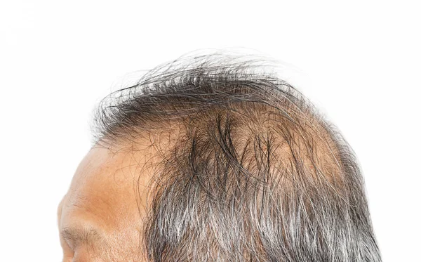 Выпадение волос, мужская голова с симптомами выпадения волос — стоковое фото