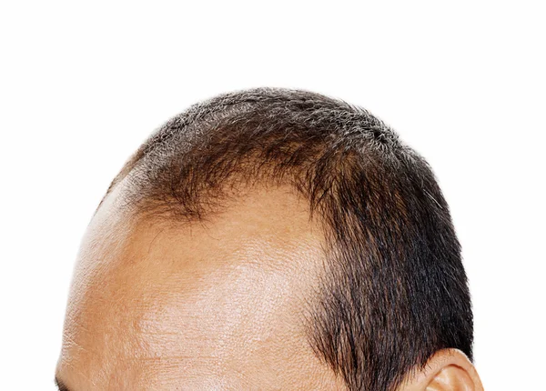 Haarausfall, männlicher Kopf mit Haarausfall-Symptomen Vorderseite. — Stockfoto