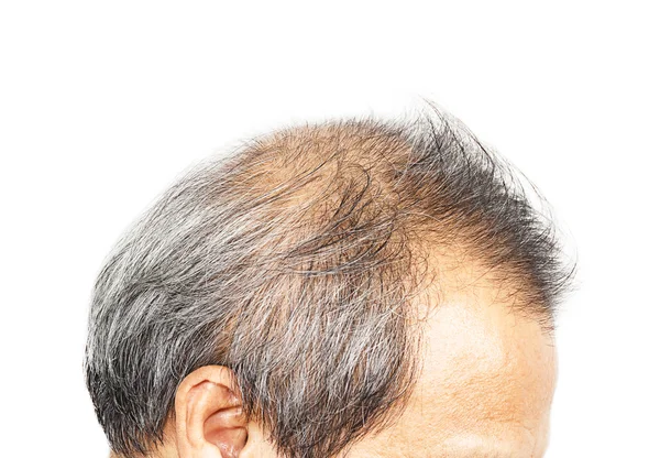 Ztráta vlasů, mužské hlavy s příznaky vypadávání vlasů — Stock fotografie
