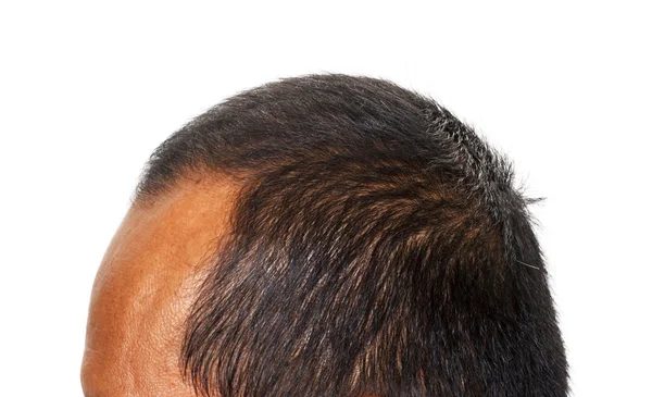 Pérdida de cabello, Cabeza masculina con pérdida de cabello, aislado en backgro blanco — Foto de Stock