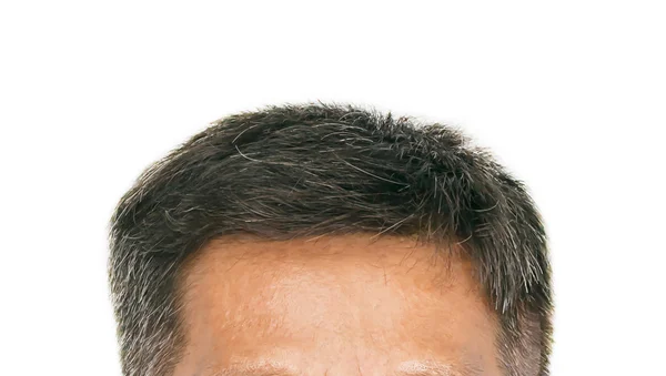  Beyaz arka plan üzerinde izole saç dökülmesi 