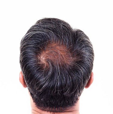hair loss and grey hair, Male head with hair loss symptoms back  clipart
