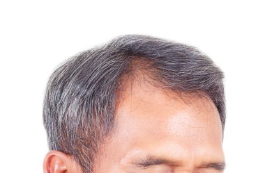 saç dökülmesi ve gri saç, saç kaybı belirtileri açık ile erkek baş