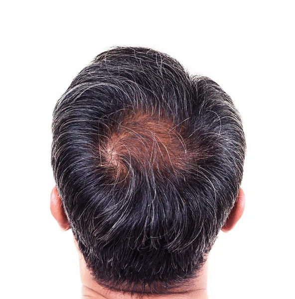 Perdita di capelli e capelli grigi, testa maschile con sintomi di perdita di capelli indietro Immagine Stock