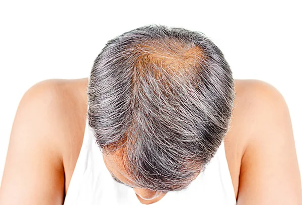 saç dökülmesi ve gri saç, erkek