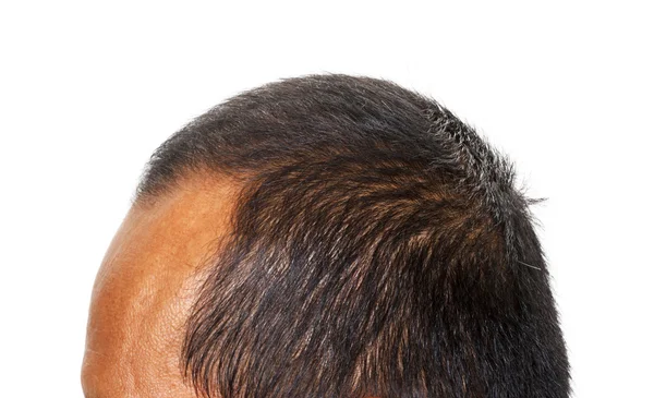 Pérdida de cabello, Cabeza masculina con pérdida de cabello, aislado en backgro blanco — Foto de Stock