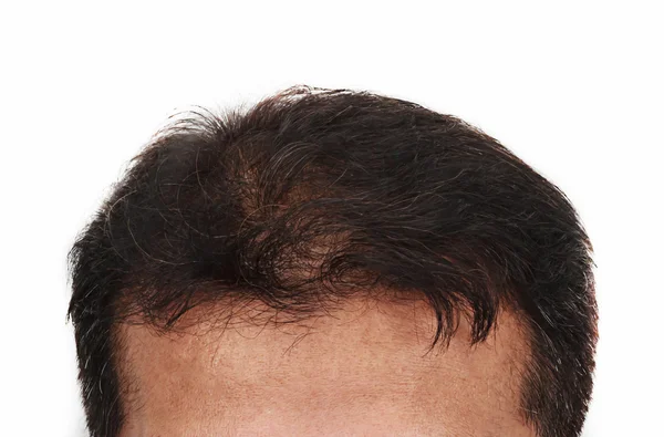 Queda de cabelo, cabeça masculina com sintomas de perda de cabelo frente — Fotografia de Stock