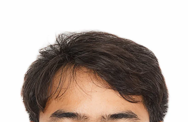 saç dökülmesi, saç kaybı belirtileri ile erkek baş yan ön.