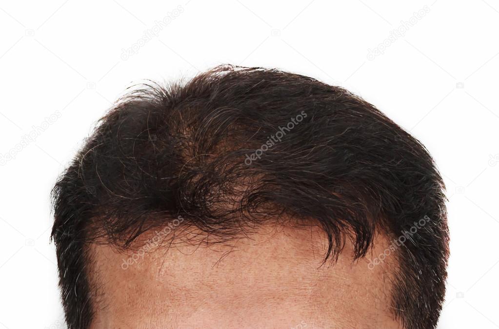 Hair loss, Male head with hair loss symptoms front side Stock Photo by  ©phatthanit 91424874