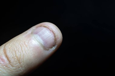 Tırnaklarını yeme alışkanlığı. Ayak tırnağını yakın plan yemiş..